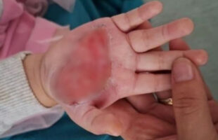 Madrasta é presa após queimar a mão de enteada de 2 anos com colher quente em Itajaí