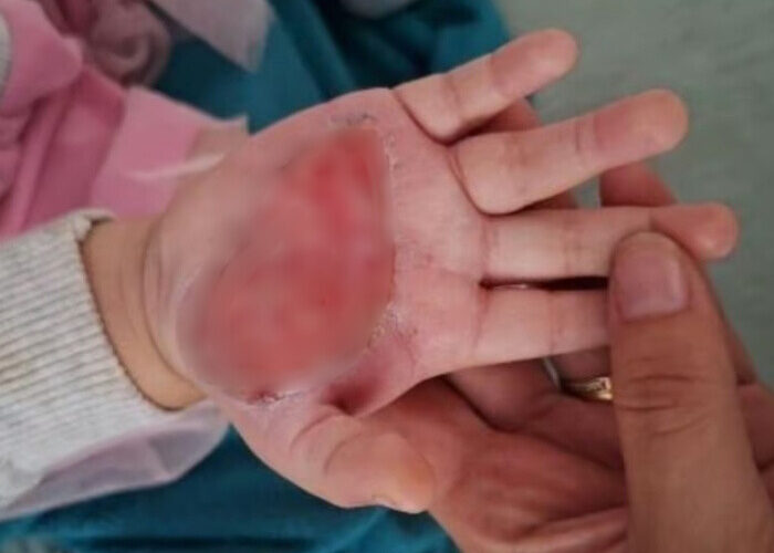 Madrasta é presa após queimar a mão de enteada de 2 anos com colher quente em Itajaí