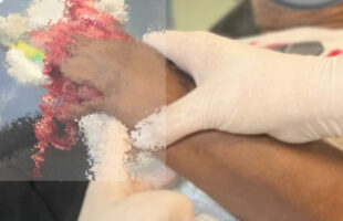 Acidente com foguete deixa homem gravemente ferido em Içara