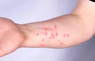 Santa Catarina registra seis casos suspeitos de mpox em 2026