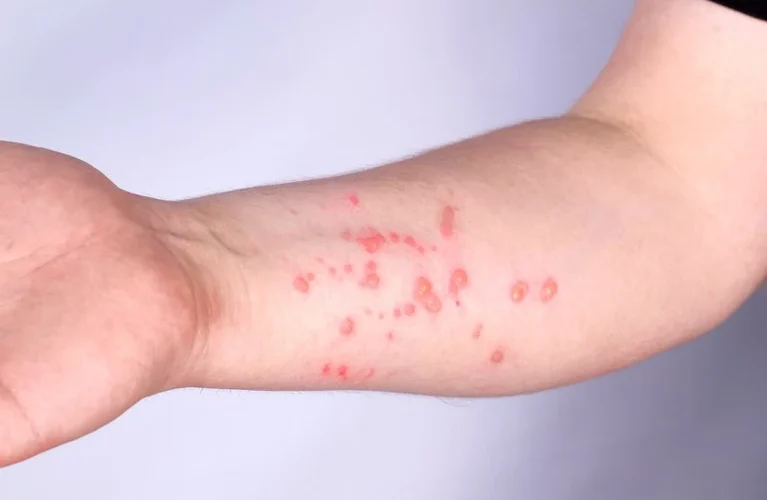 Santa Catarina registra seis casos suspeitos de mpox em 2026