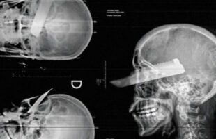 Homem cheira cocaína, bebe a noite toda e crava faca no rosto da esposa