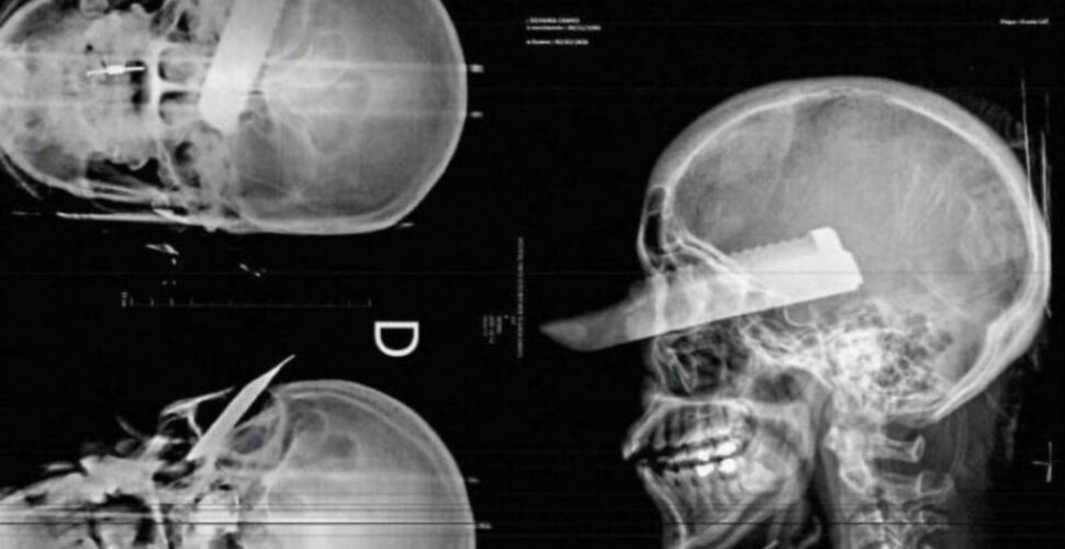 Homem cheira cocaína, bebe a noite toda e crava faca no rosto da esposa