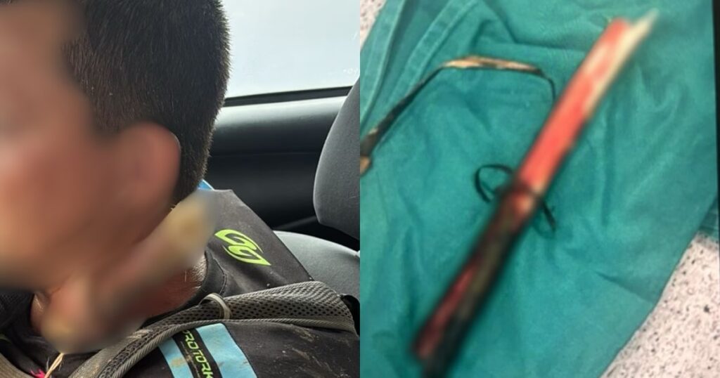 Galho atravessa pescoço de trilheiro e homem sobrevive em SC