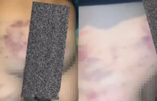 Menino de 5 anos é vítima de agressão e pai é investigado por maus-tratos em Sangão