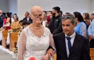 Catarinense que enfrentou 73 cânceres de pele se casa com companheiro que a apoiou durante o tratamento